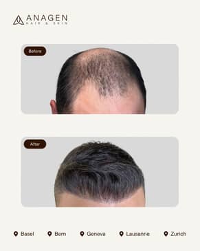 Slider image (5) Anagen - Hair Transplant Clinic in Switzerland